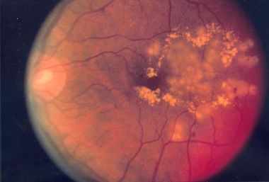 800px-Fundus_photo_showing_focal_laser_surgery_for_diabetic_retinopathy_EDA10